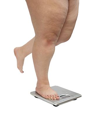 obesity feet