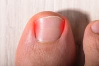 All About Surgery for Ingrown Toenails
