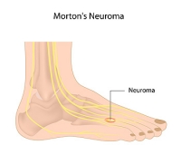 What Are the Common Symptoms of Morton’s Neuroma?