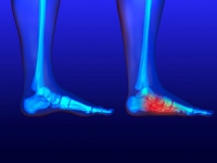 What Causes Flat Feet?