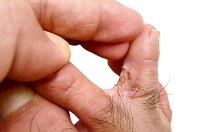 Differences Between Athlete’s Foot and Eczema