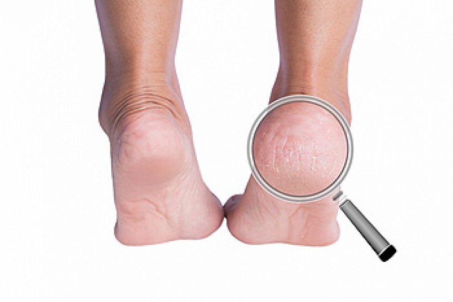 Cracked Heels - Ottawa Foot Clinic