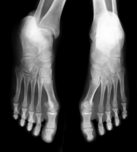 How Stress Fracture Healing Time May Be Linked to BMI