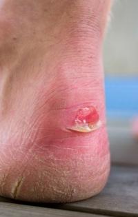How to Prevent Blisters