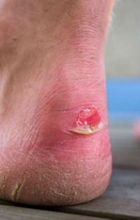 What Causes Blisters?