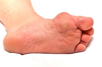 Who Is Most Susceptible To Getting Gout?