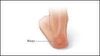 Blisters Develop after Repeated Friction