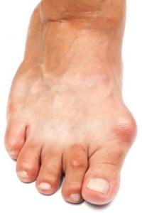 Winter Shoes May Affect Bunions