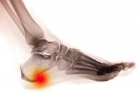 Causes and Treatment of Heel Spurs