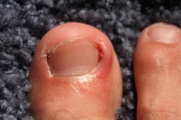 Are Ingrown Toenails Painful?