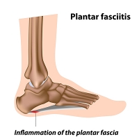 Signs of Plantar Fasciitis